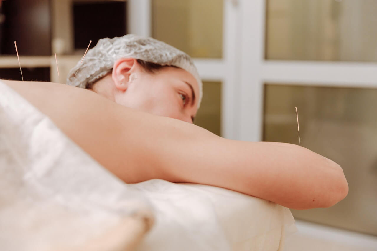 Patient receives acupuncture treatment on arm in clinical wellness setting