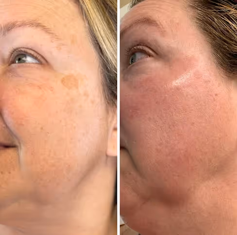 Side-by-side close-up of a woman's cheek showing brown spots before treatment and clearer skin with reduced spots after treatment.
