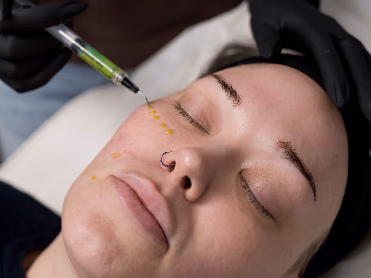 Close-up of a woman receiving yellow dots of cosmetic treatment around her eye from a person wearing black gloves.