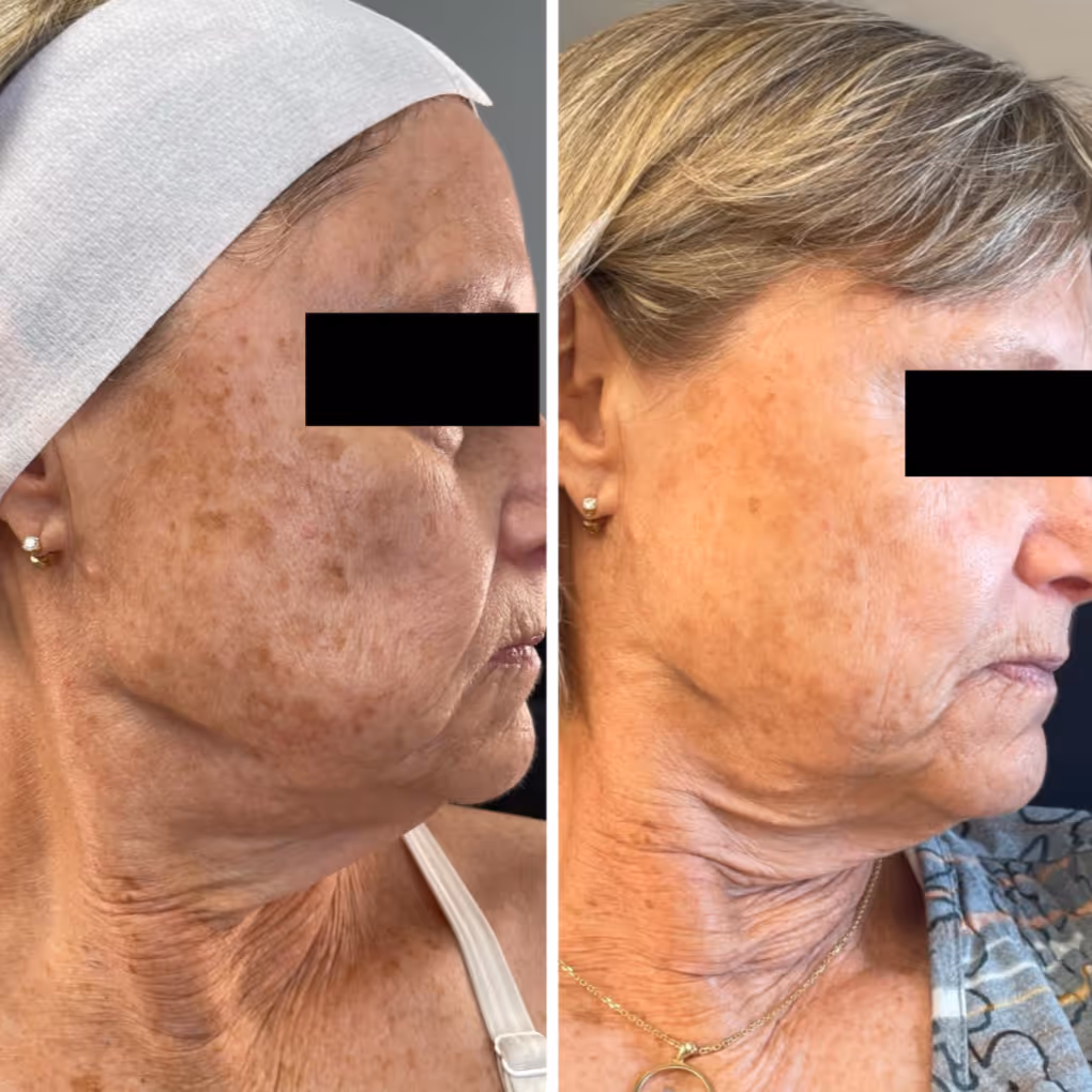 Side-by-side before and after photos of an older woman showing reduced dark age spots and more even skin tone after treatment.
