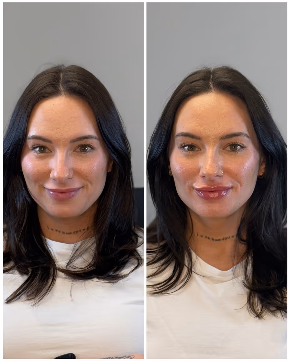 Side-by-side close-up portraits of a woman before and after lip filler treatment, showing fuller, glossier lips in the after image.