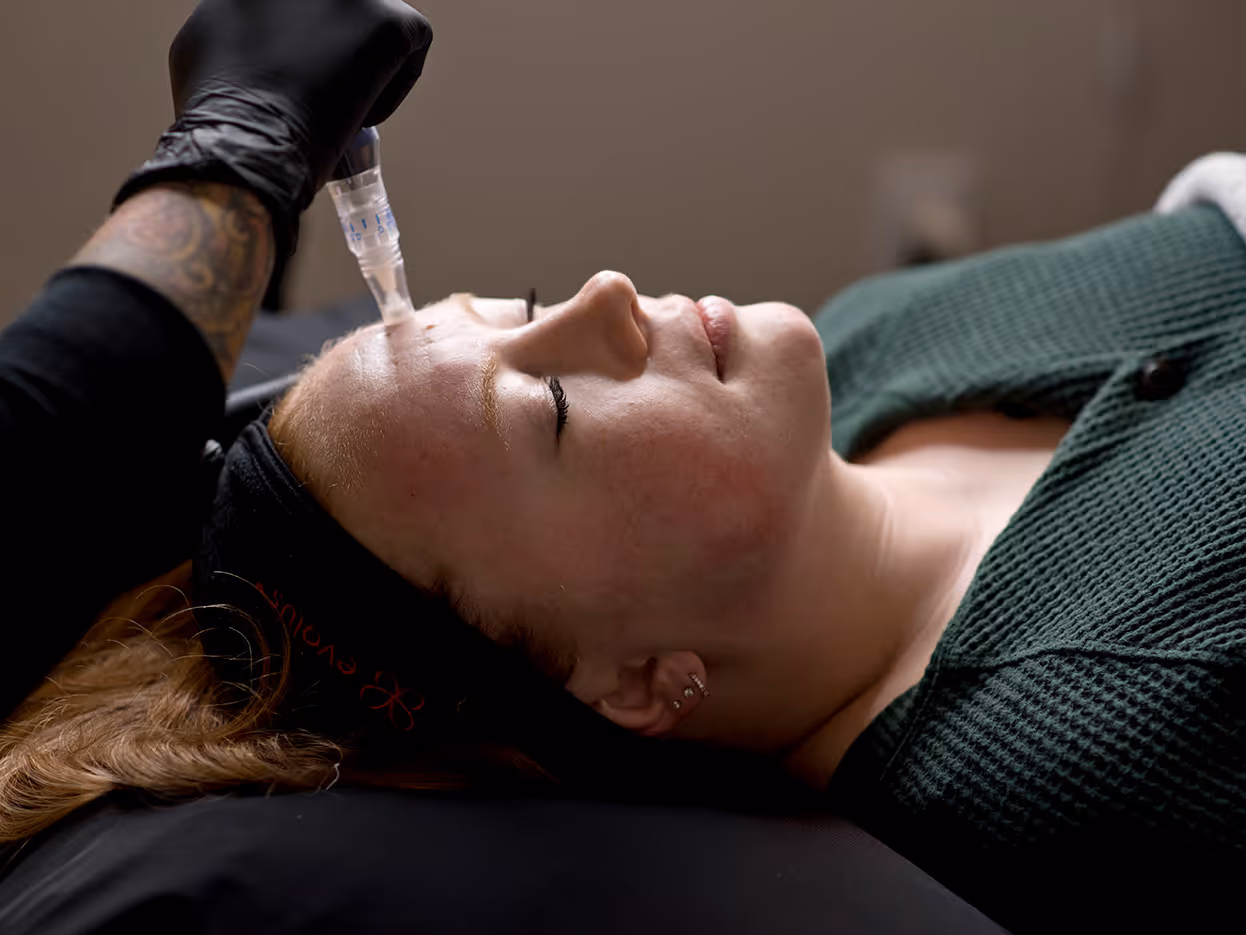 Woman receiving a microneedling facial treatment with a handheld device on her forehead, eyes closed and relaxed.