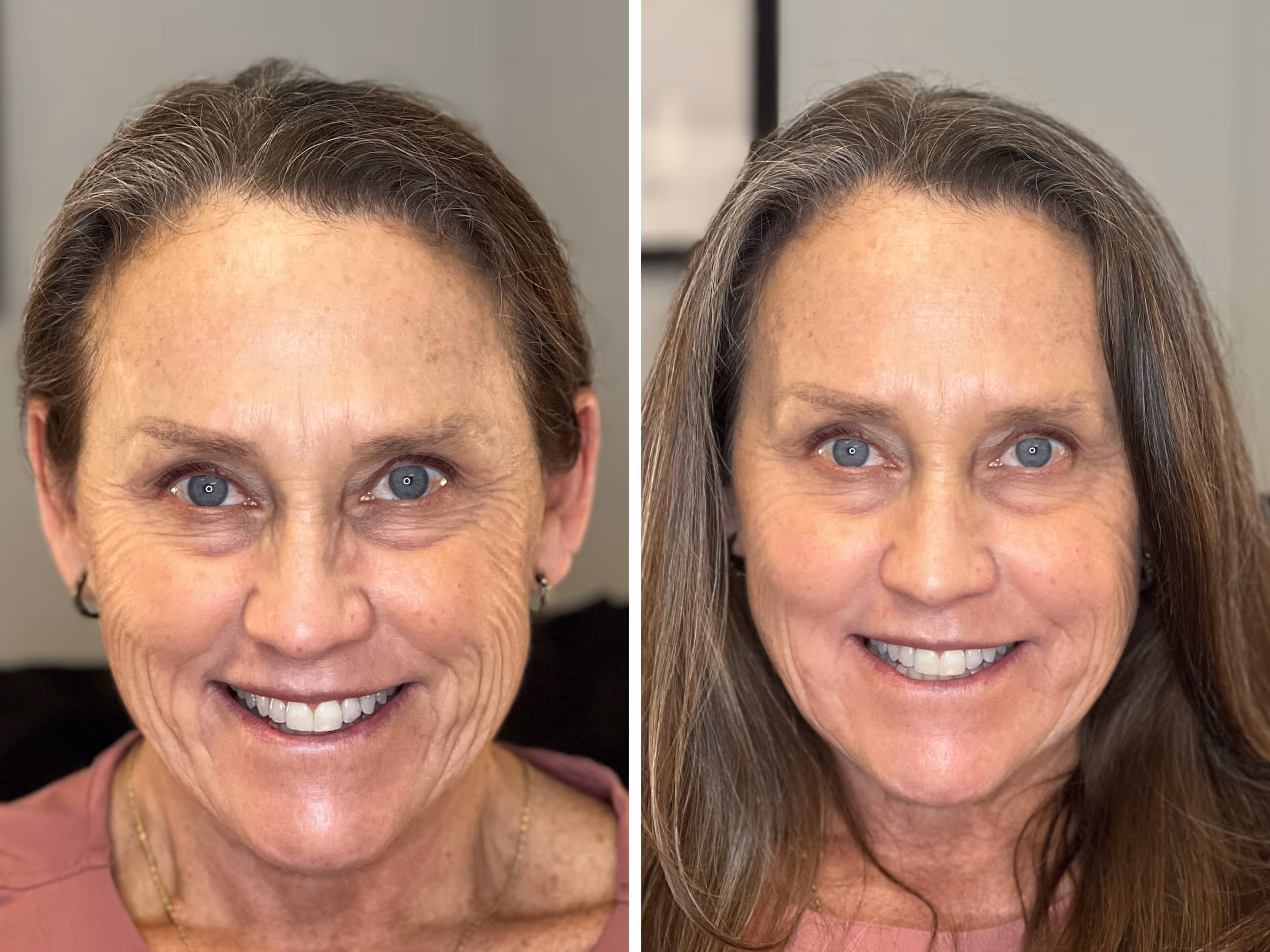 Side-by-side comparison of a smiling middle-aged woman showing reduced facial wrinkles and fuller hair after treatment.