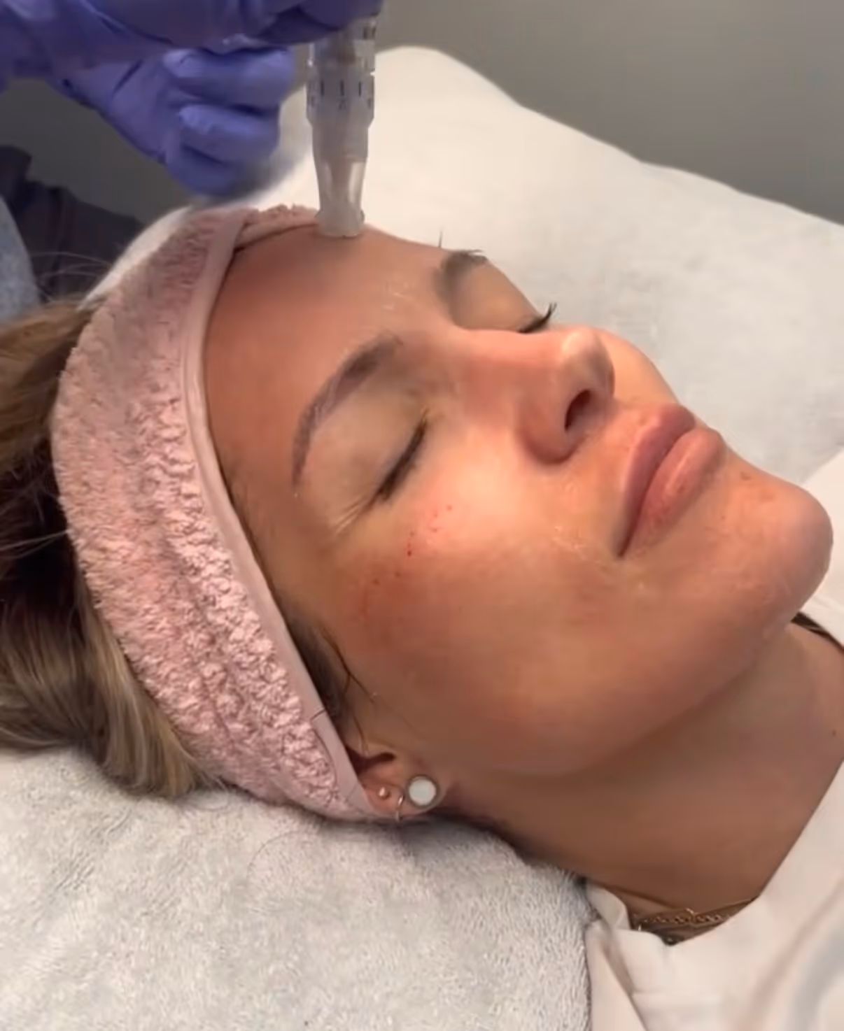 Woman receiving a microneedling facial treatment on her forehead while lying on a spa bed.