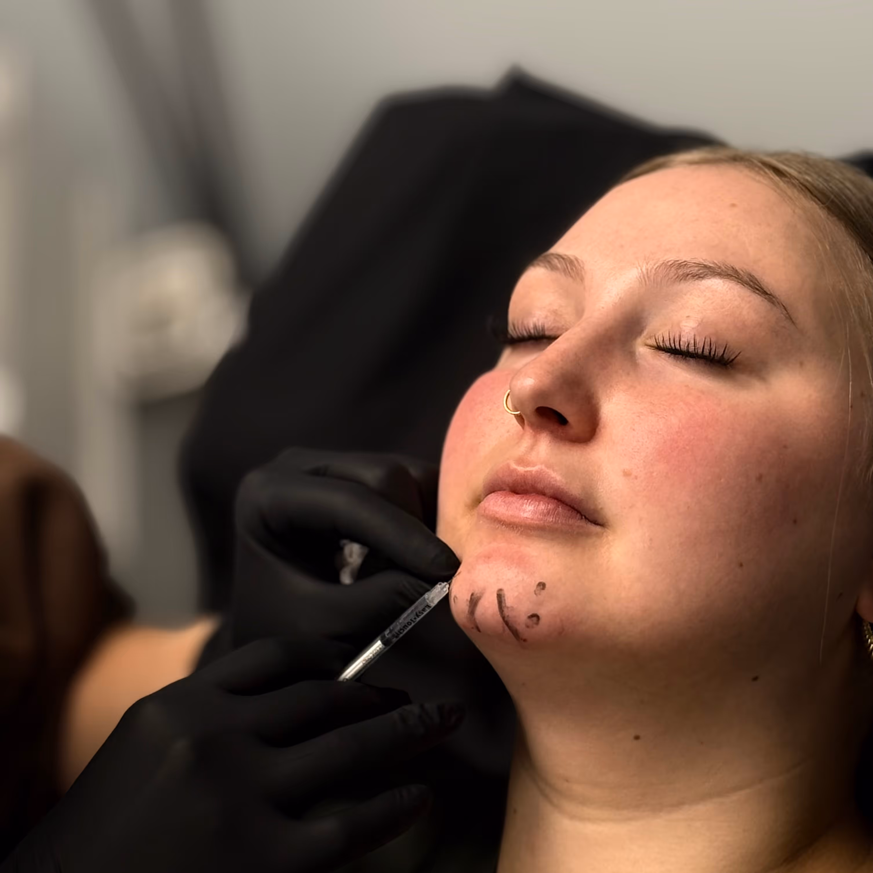 Close-up of a person with eyes closed receiving a chin filler injection with black markings on the chin.