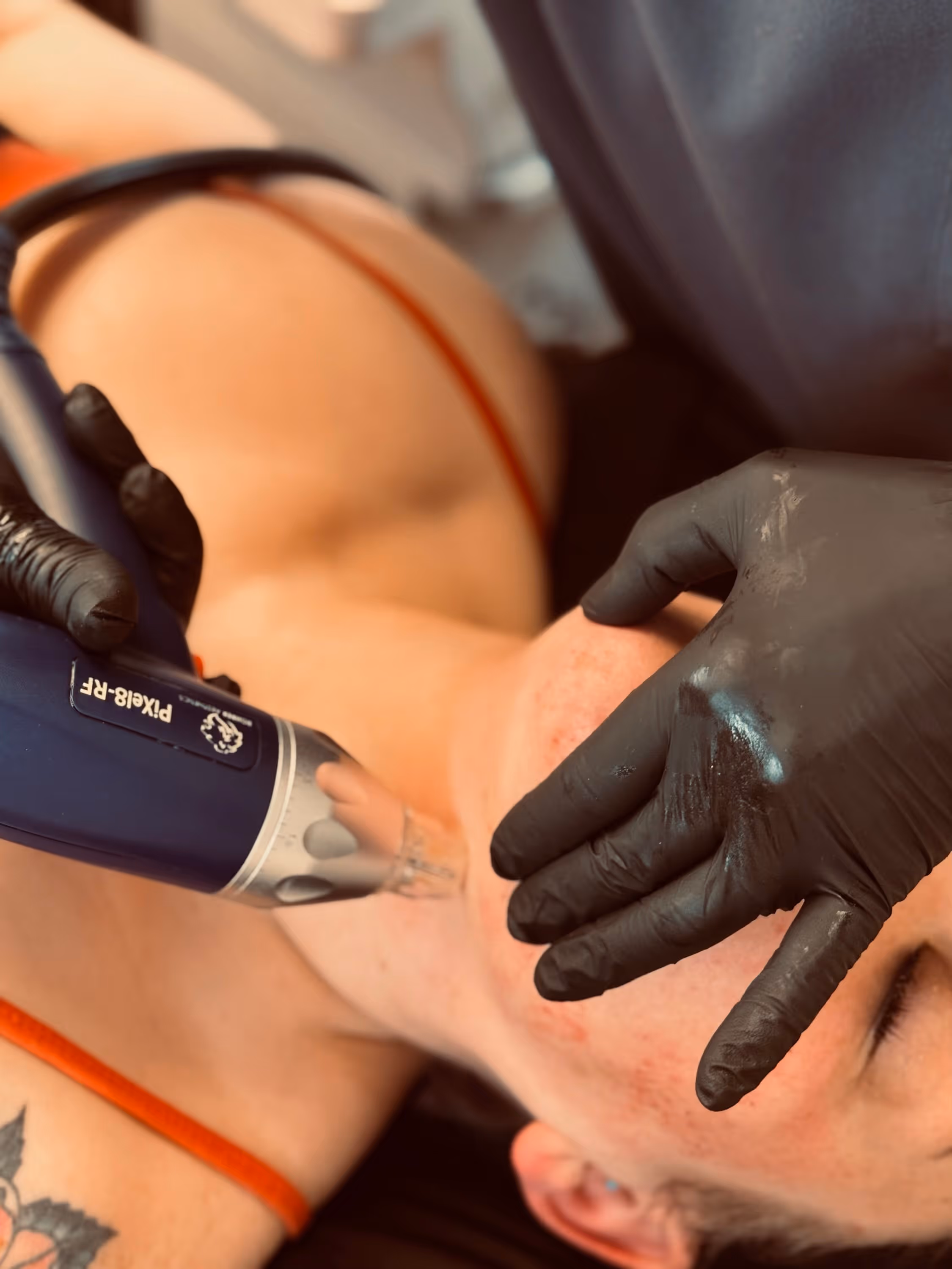 Close-up of a person receiving a facial microneedling treatment with a Pixel8-RF device on their jawline, technician wearing black gloves.
