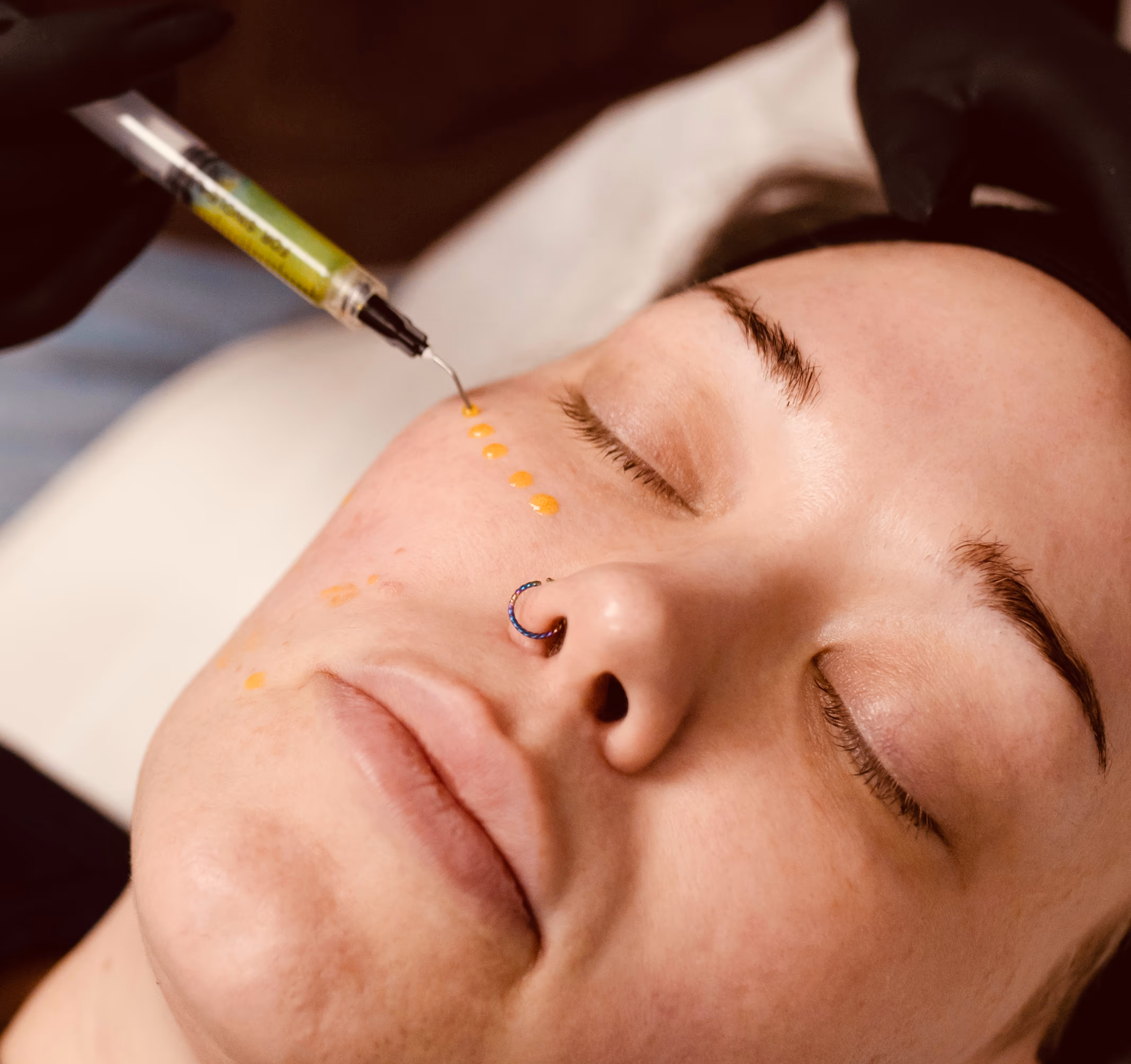 Close-up of a person with closed eyes receiving small yellow dots of chemical peel applied on their cheek near the eye by a gloved professional.