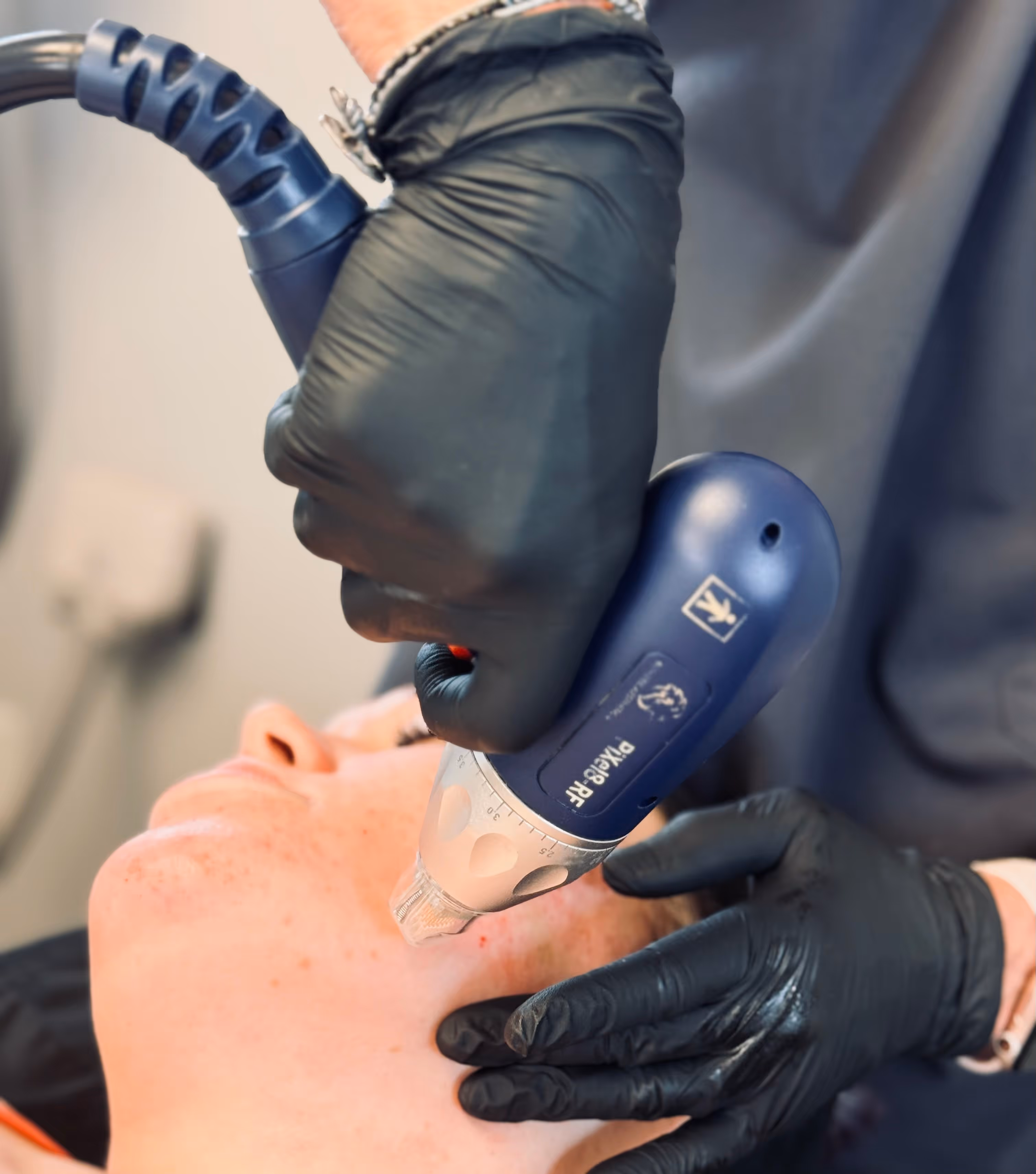 Close-up of a professional wearing black gloves performing a microneedling RF treatment on a person's jawline using a blue device.