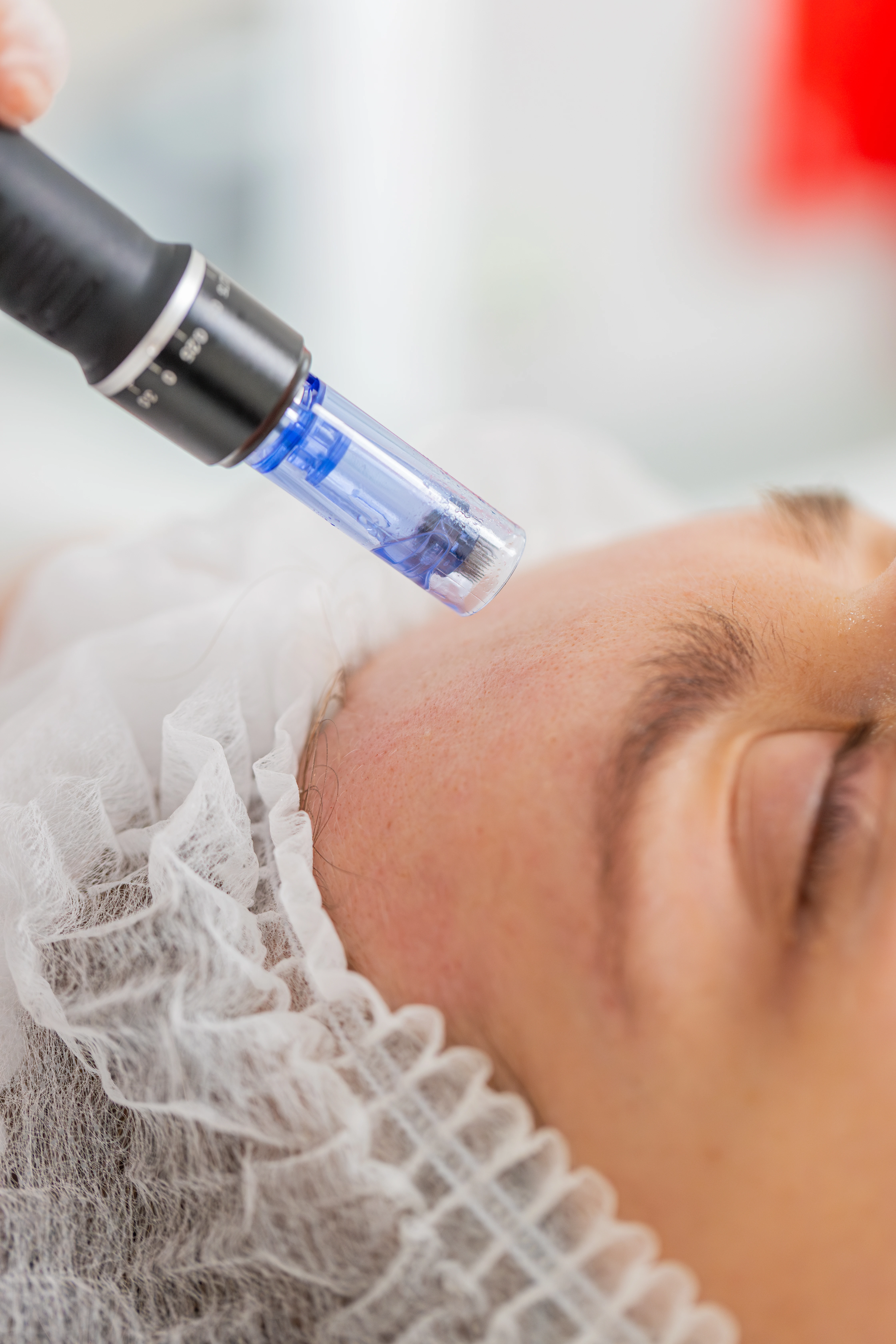 Close-up of a cosmetologist performing a skin peeling treatment on a patient's face with a blue device.