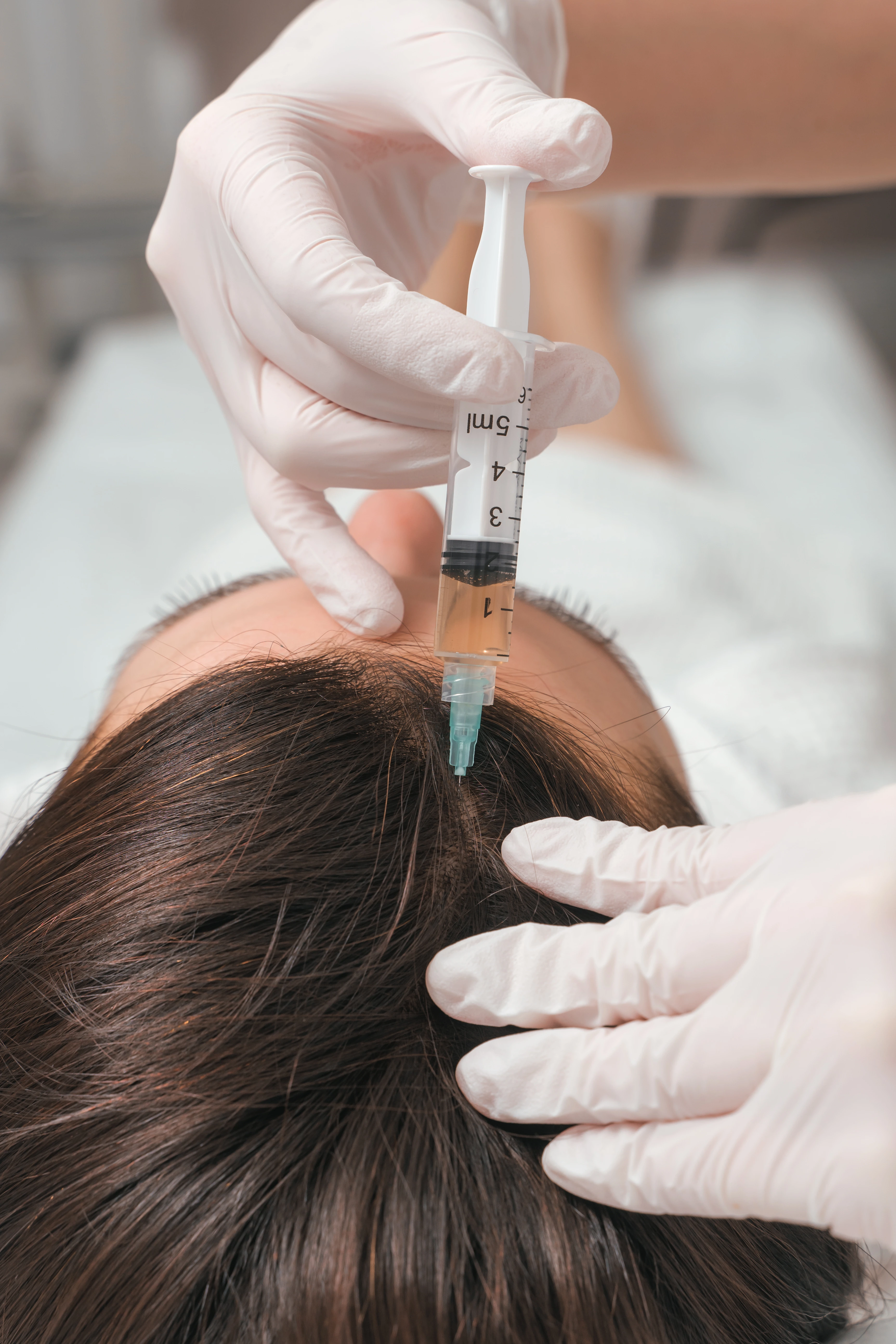 Gloved hands inject serum into the scalp of a person with dark hair for hair treatment.