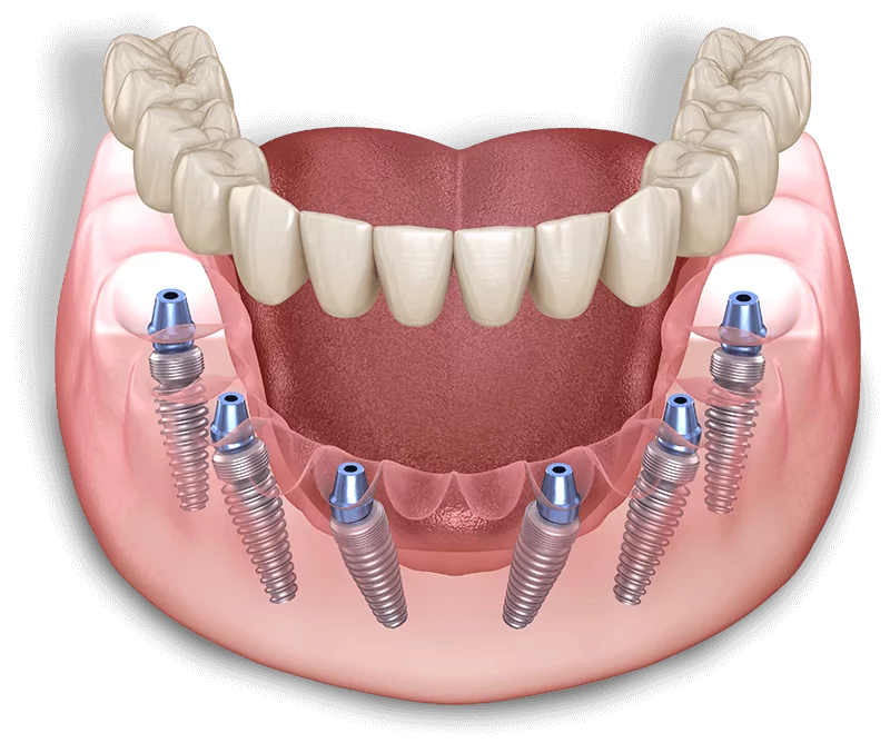 Full-arch dental implant restoration model at Arvada Dental Center & Implants