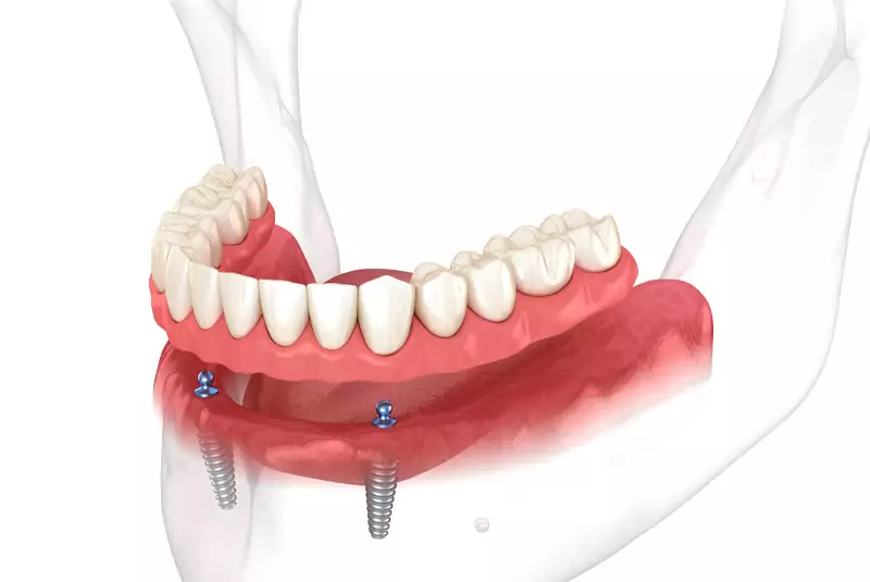 Implant supported snap-on dentures at Arvada Dental Center & Implants in Arvada, CO