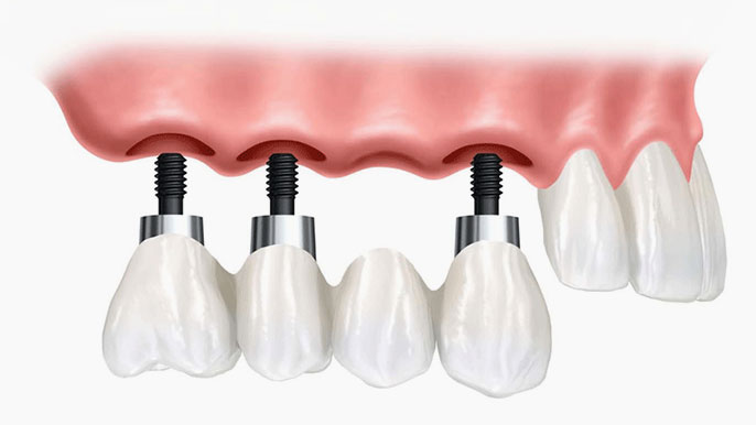 Fixed zirconia All-On-X implant bridge at Arvada Dental Center & Implants in Arvada, CO