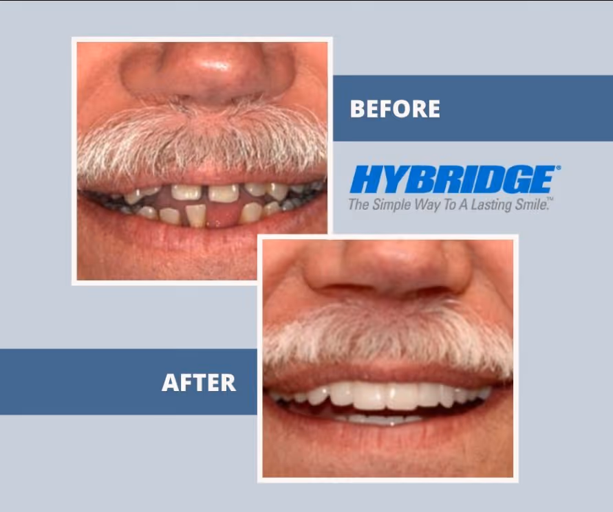 Full arch dental implant lip close-up before and after at Arvada Dental Center & Implants in Arvada, CO