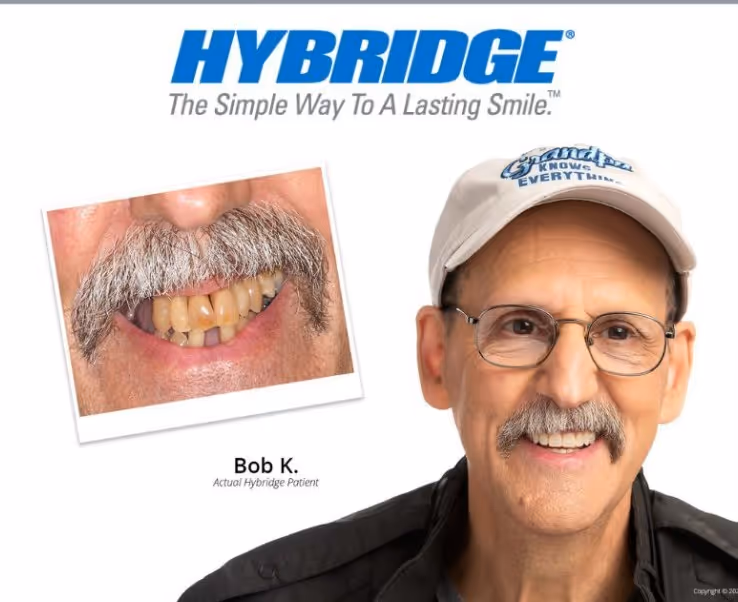 Full arch dental implant patient Bob at Arvada Dental Center & Implants in Arvada, CO