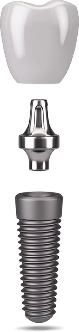 Single dental implant model in Arvada Dental Center & Implants