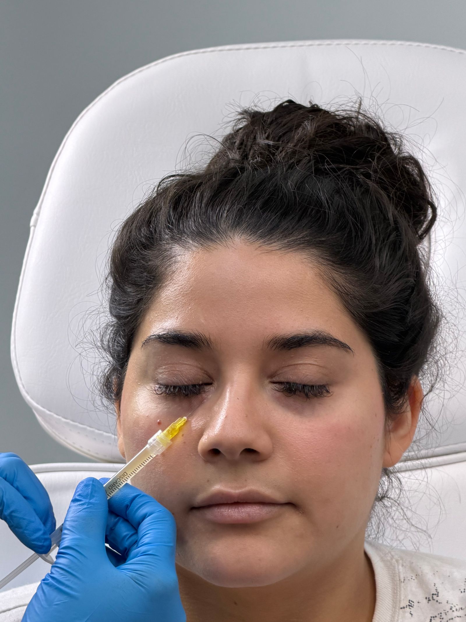 Close-up of a woman's under-eye area being assessed before an injectable skin treatment at a London aesthetics clinic