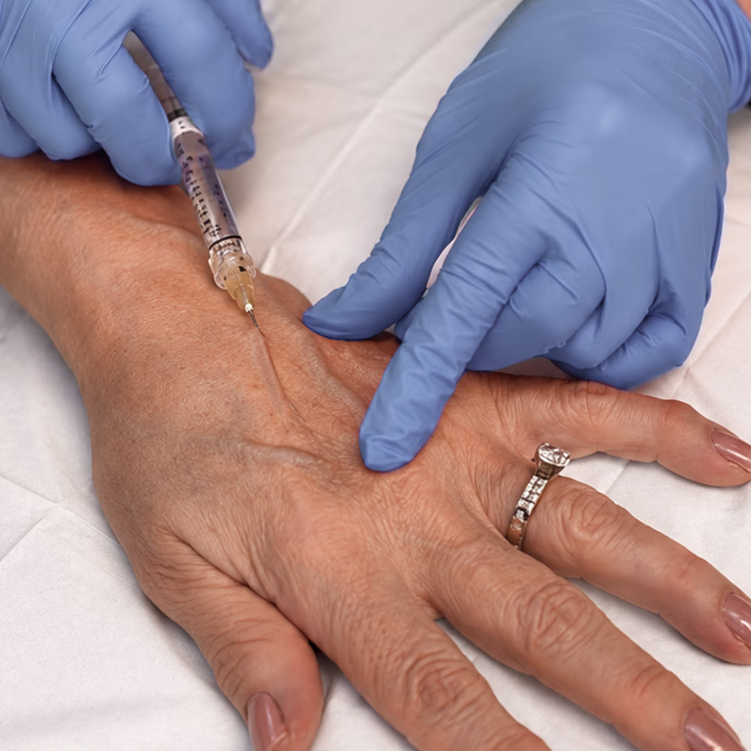 Hand Rejuvenation