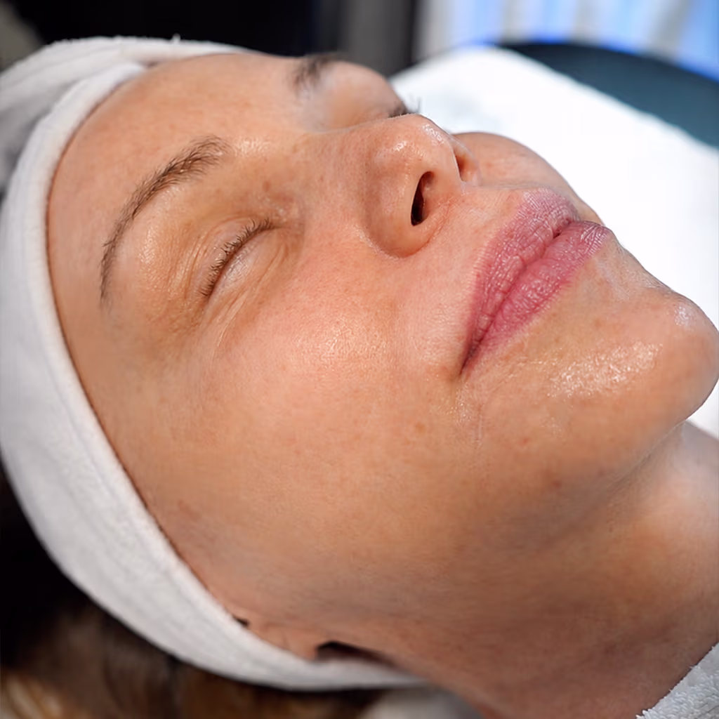 The Perfect Derma ™ Peel Package