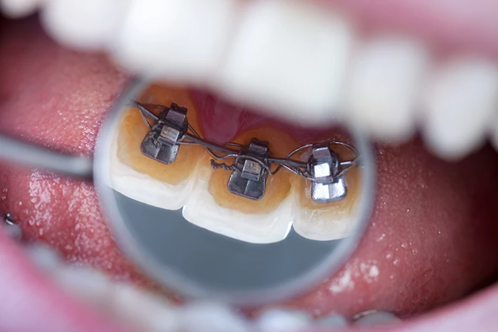 Close-up of dental braces on teeth with a dental mirror reflecting three brackets and wires.