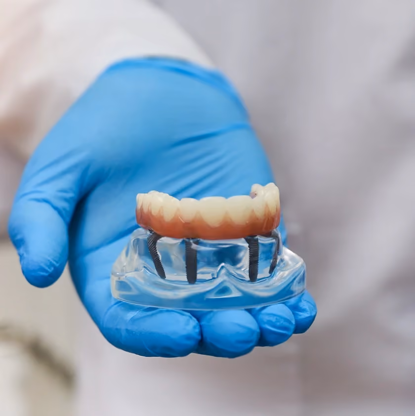 Hand in blue glove holding dental implant model with artificial teeth and screws.