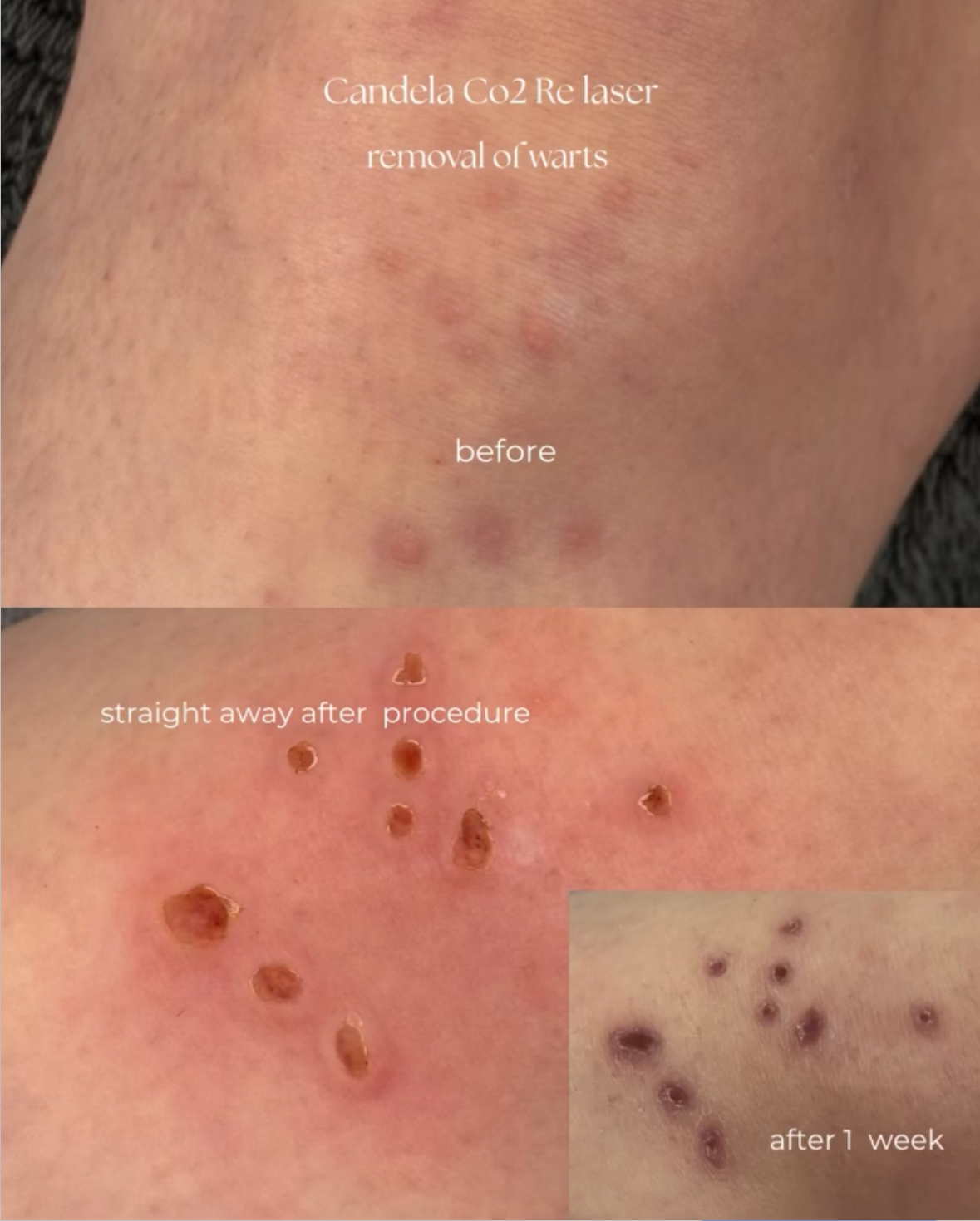 Wart Removal Aftercare BeautyGene Clinic