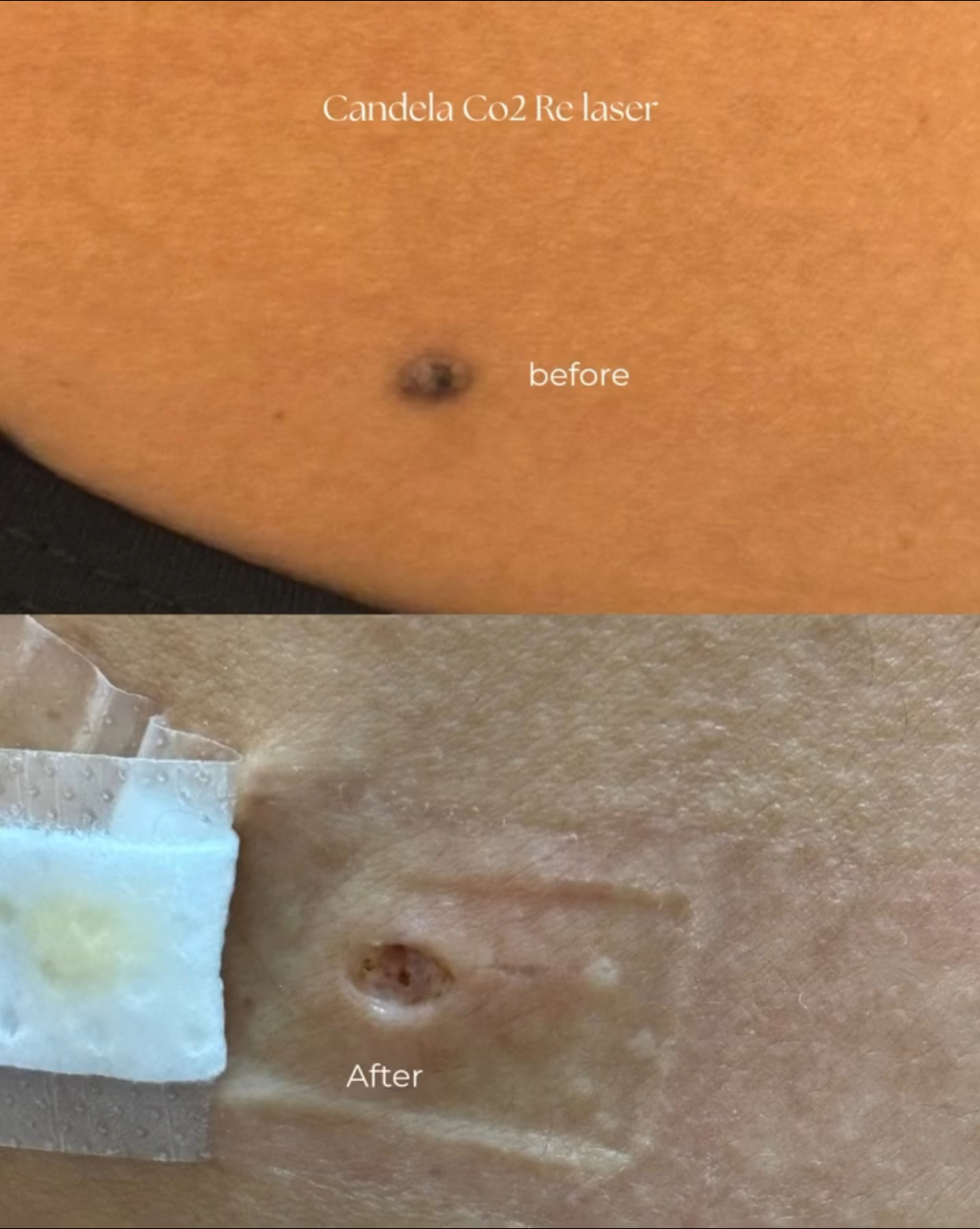 Papilloma Treatment Result 6