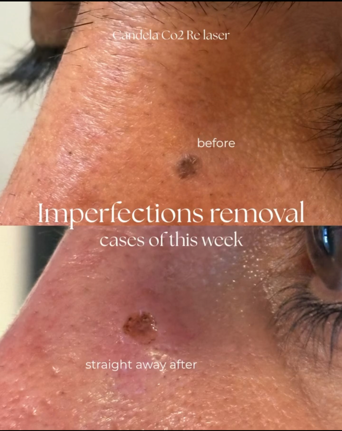 Papilloma Treatment Result 5