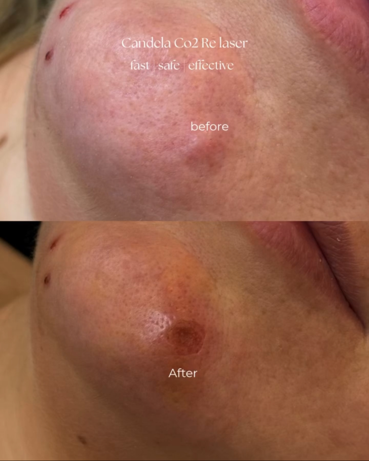 Papilloma Treatment Result 4