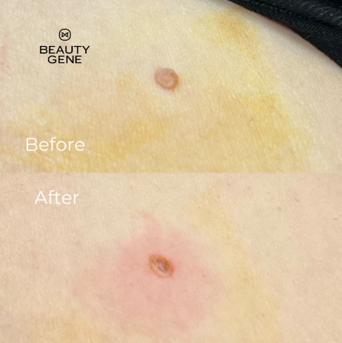Papilloma Treatment Result 3