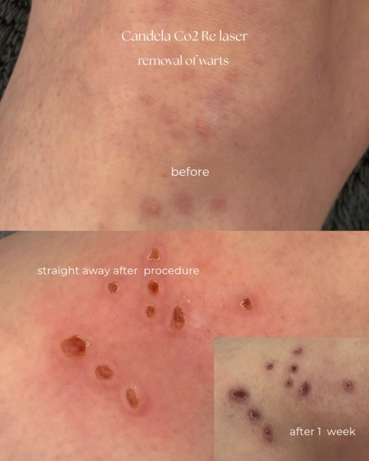 Papilloma Treatment Result 2
