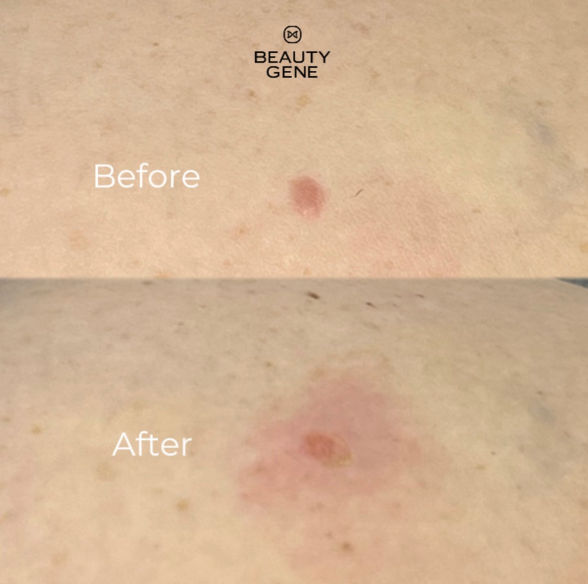Papilloma Treatment Result 1