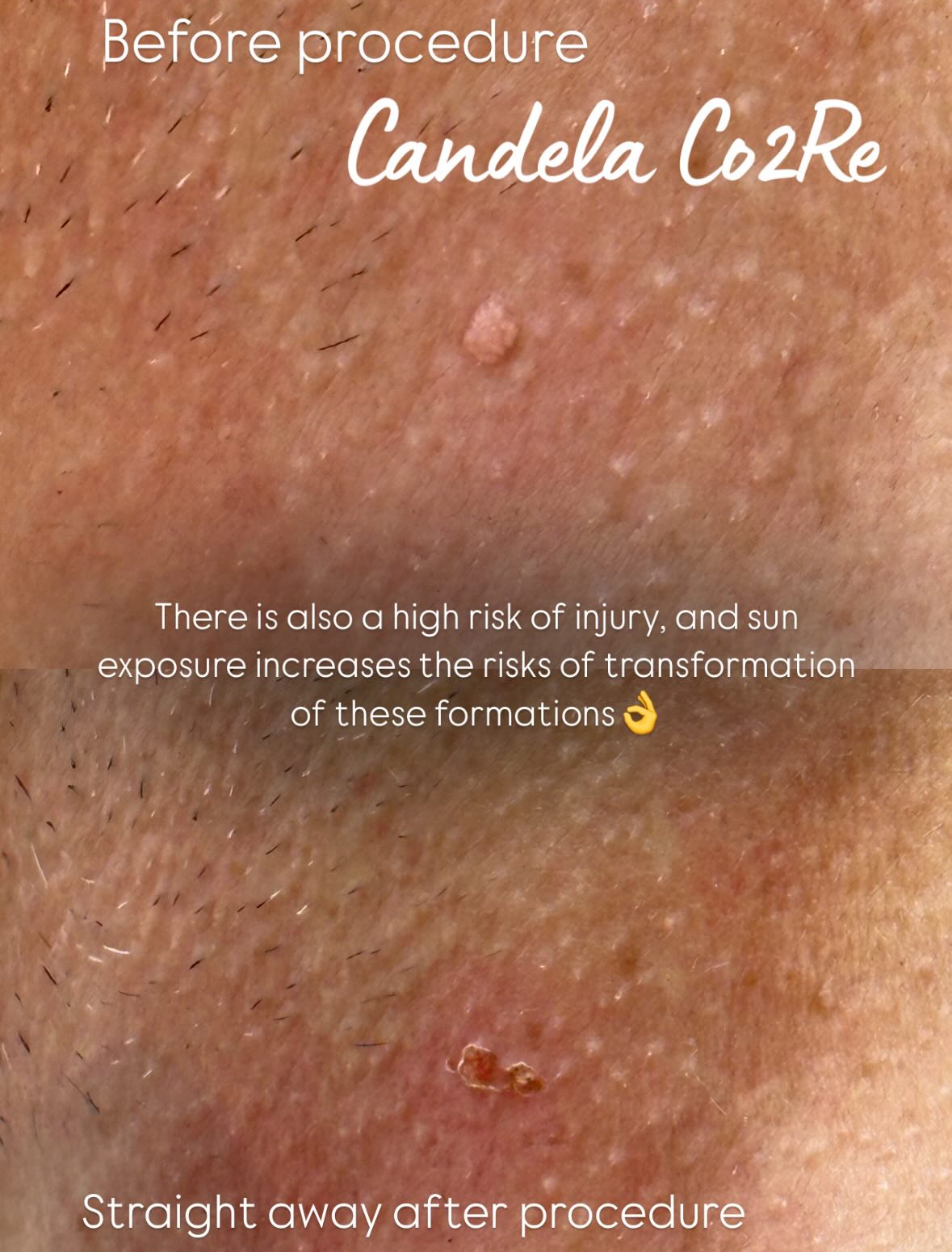Papilloma Removal Aftercare BeautyGene Clinic
