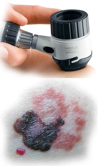 Dermatoscopy BeautyGene Clinic