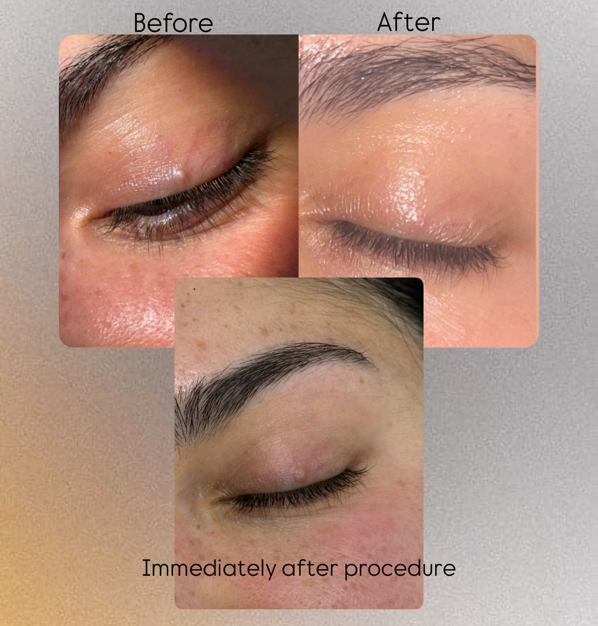 Milia Removal Aftercare BeautyGene Clinic