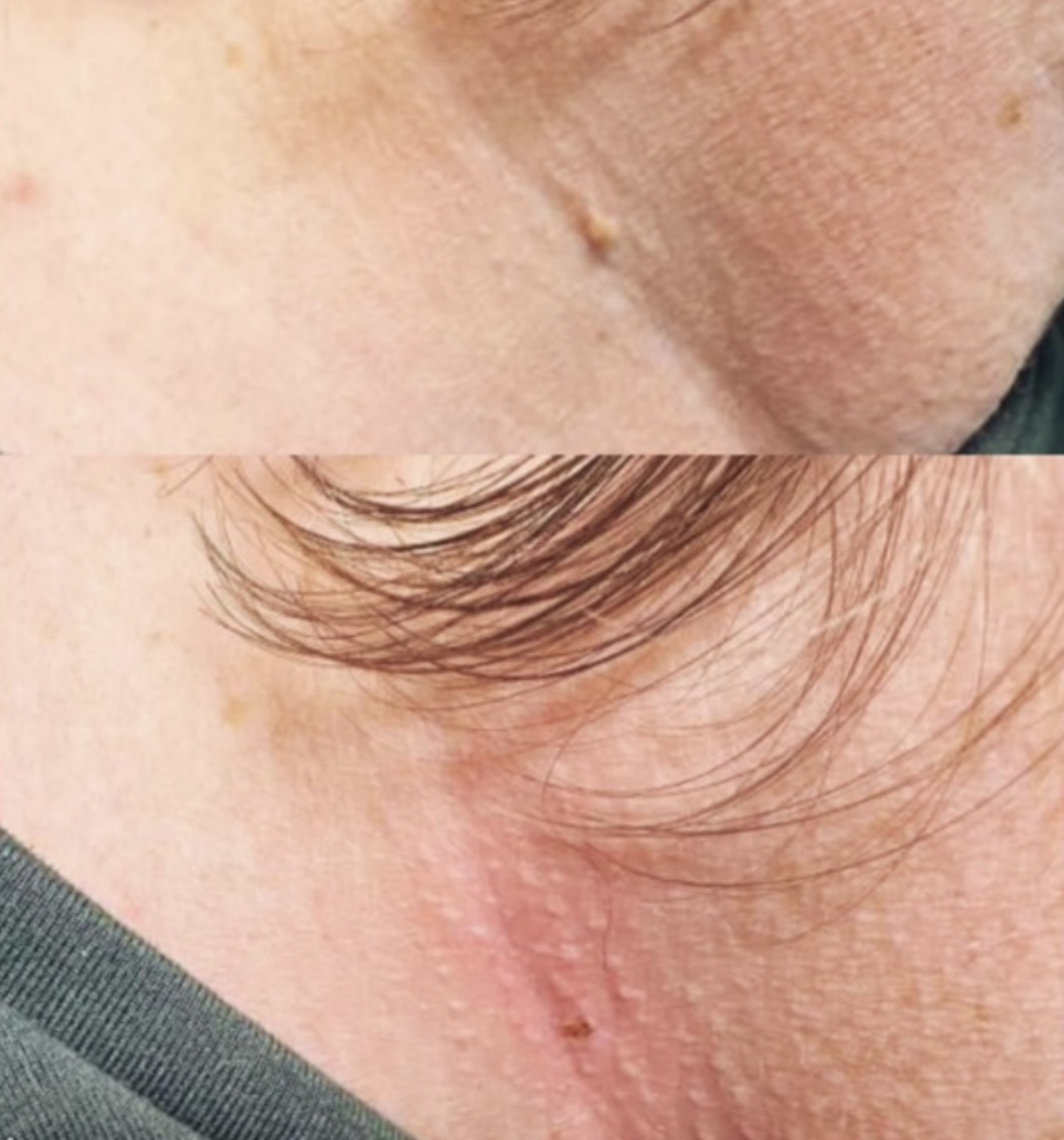 Skin Tag Removal Result 3