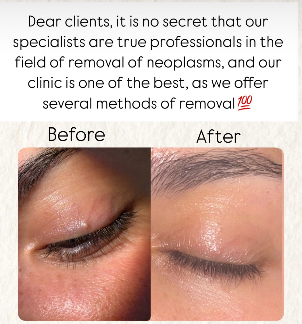 Skin Tag Removal Result 2