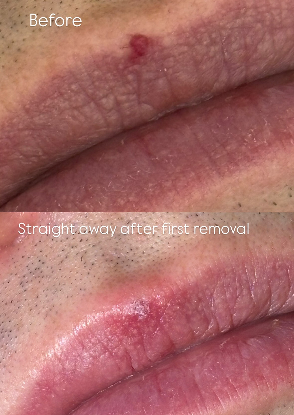 Skin Tag Removal Result 1