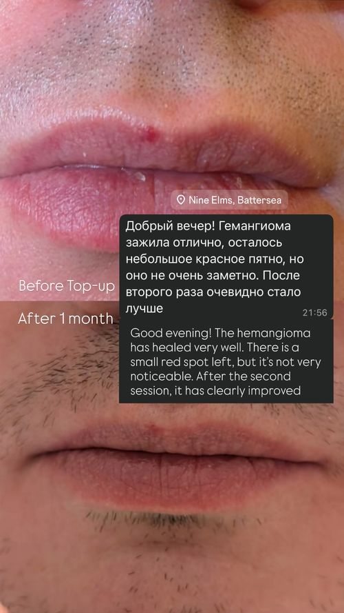 Angioma Removal Aftercare BeautyGene Clinic