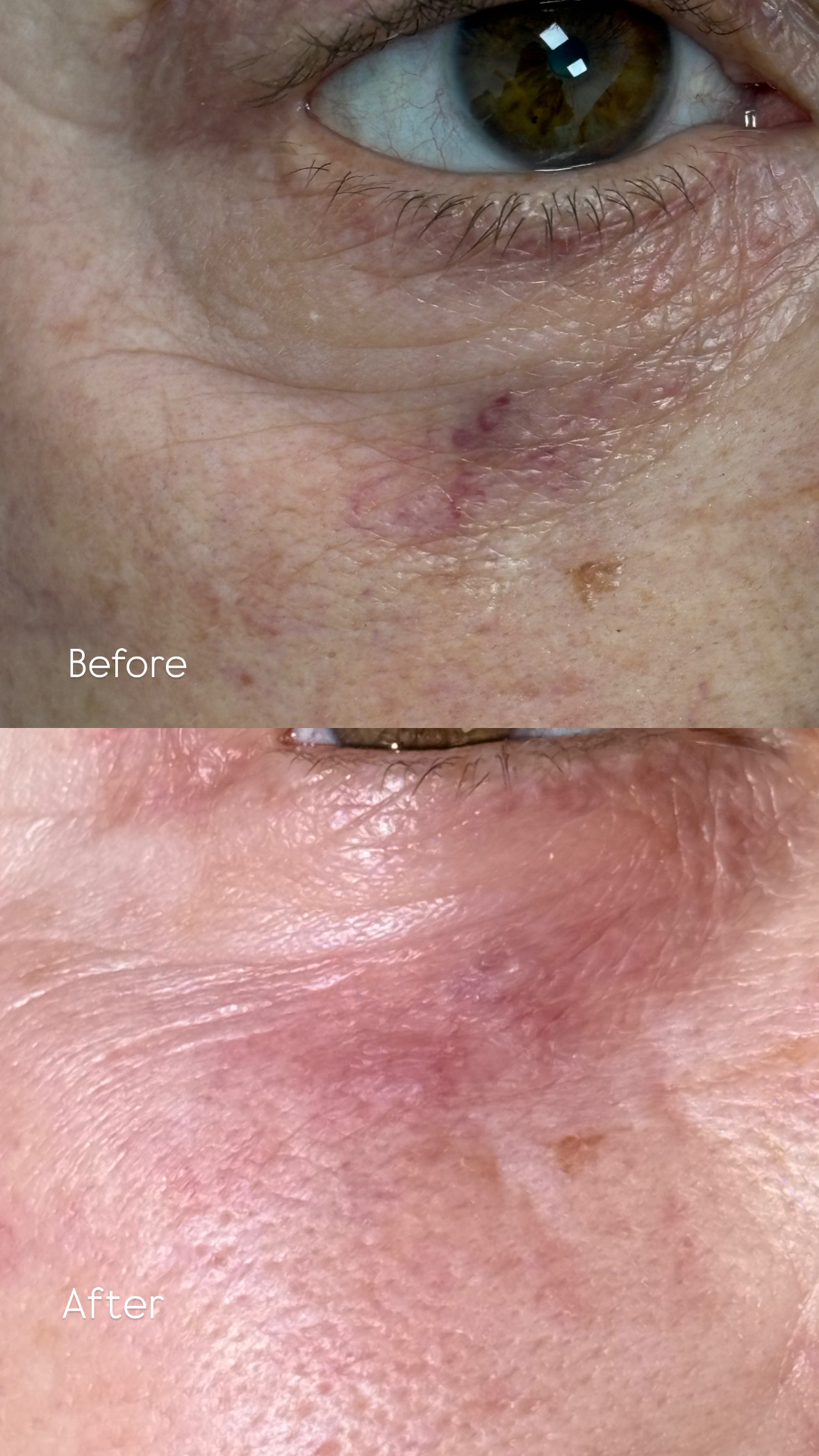 Spider Vein Removal Aftercare BeautyGene Clinic