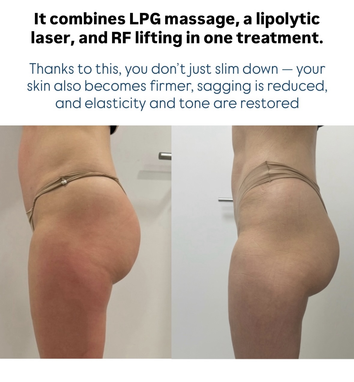 T-Shape result before after