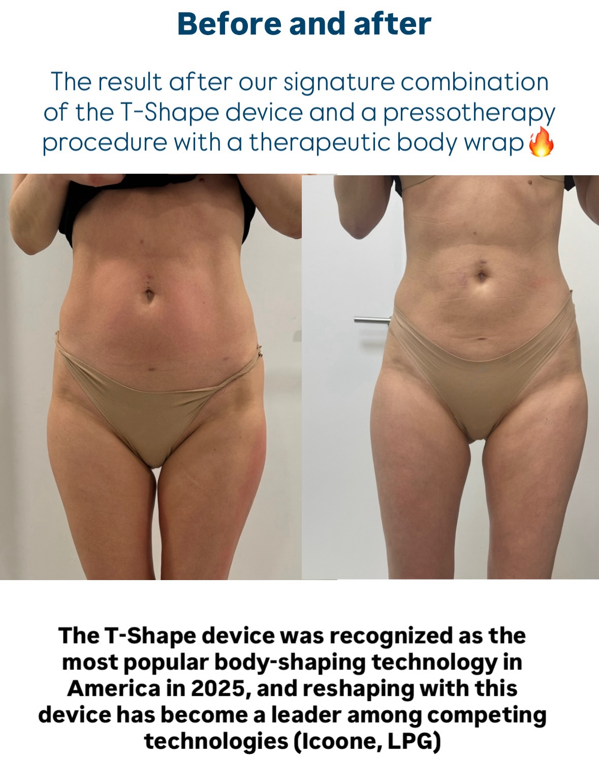 T-Shape result before after