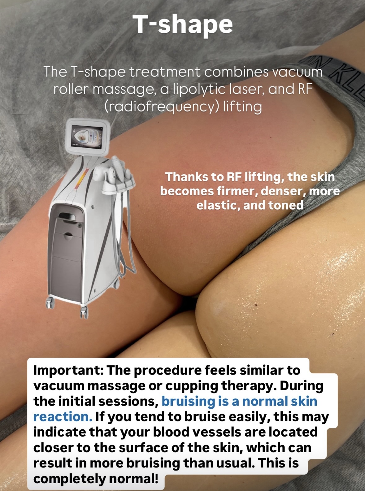 T-Shape result before after