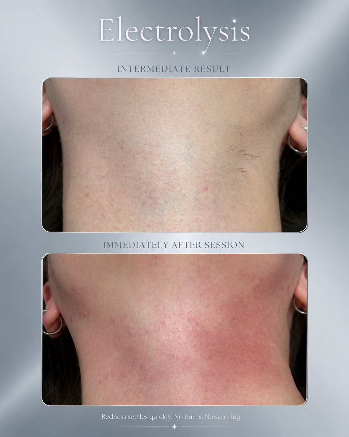Electrolysis before and after result at BeautyGene Clinic — case 1