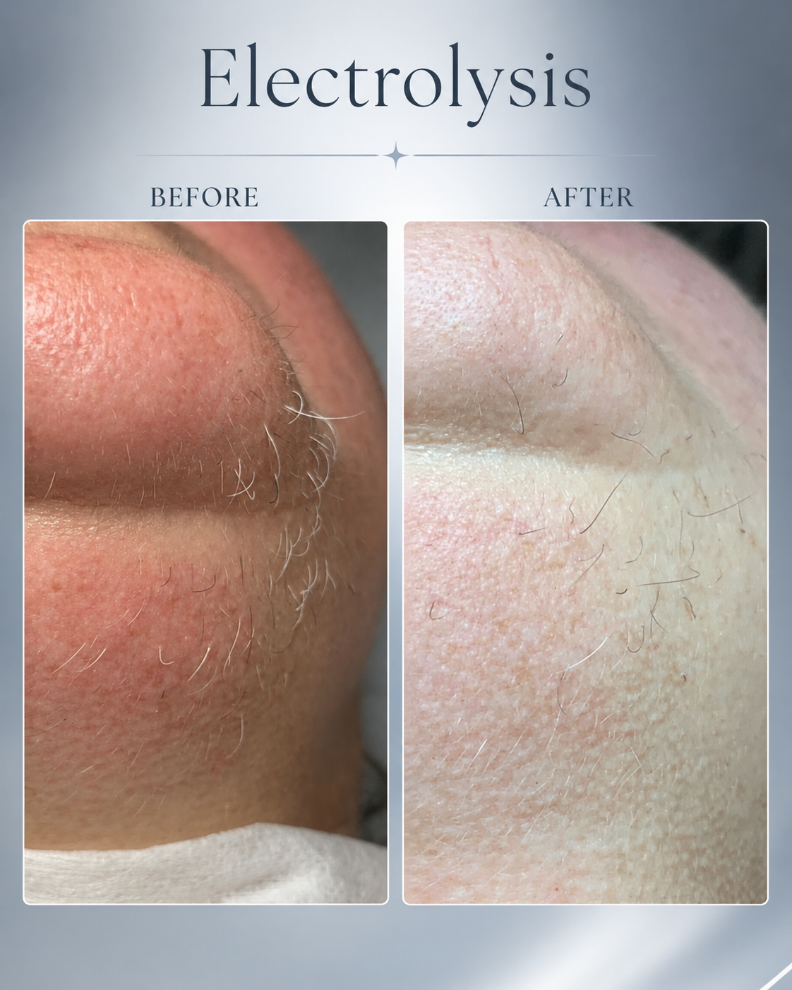 Electrolysis before and after result at BeautyGene Clinic — case 2