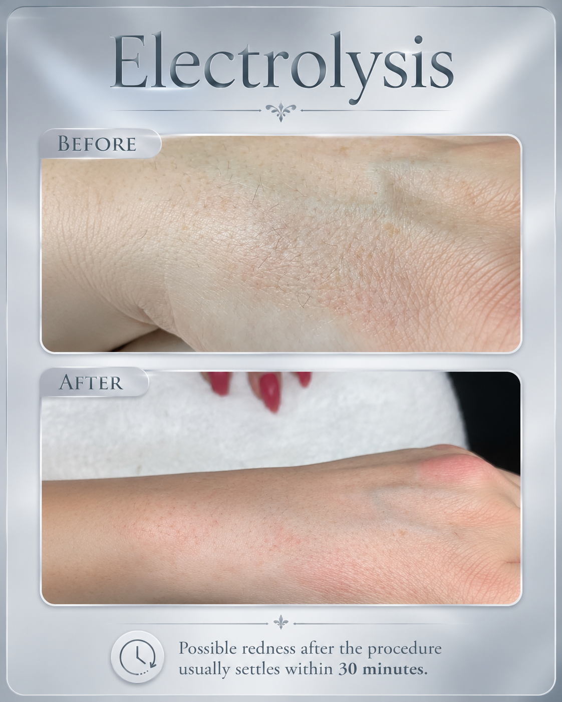 Electrolysis before and after result at BeautyGene Clinic — case 3
