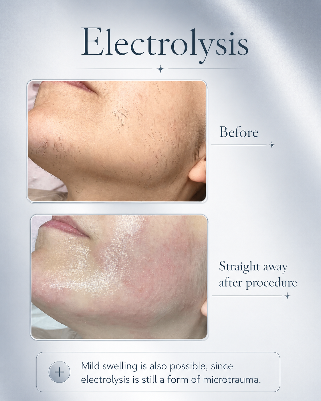 Electrolysis before and after result at BeautyGene Clinic — case 4