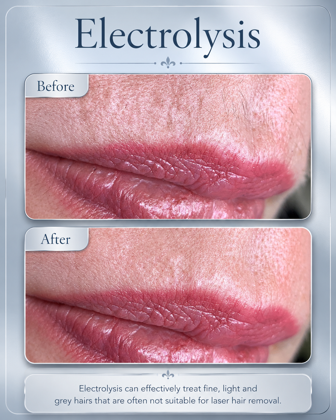Electrolysis before and after result at BeautyGene Clinic — case 5