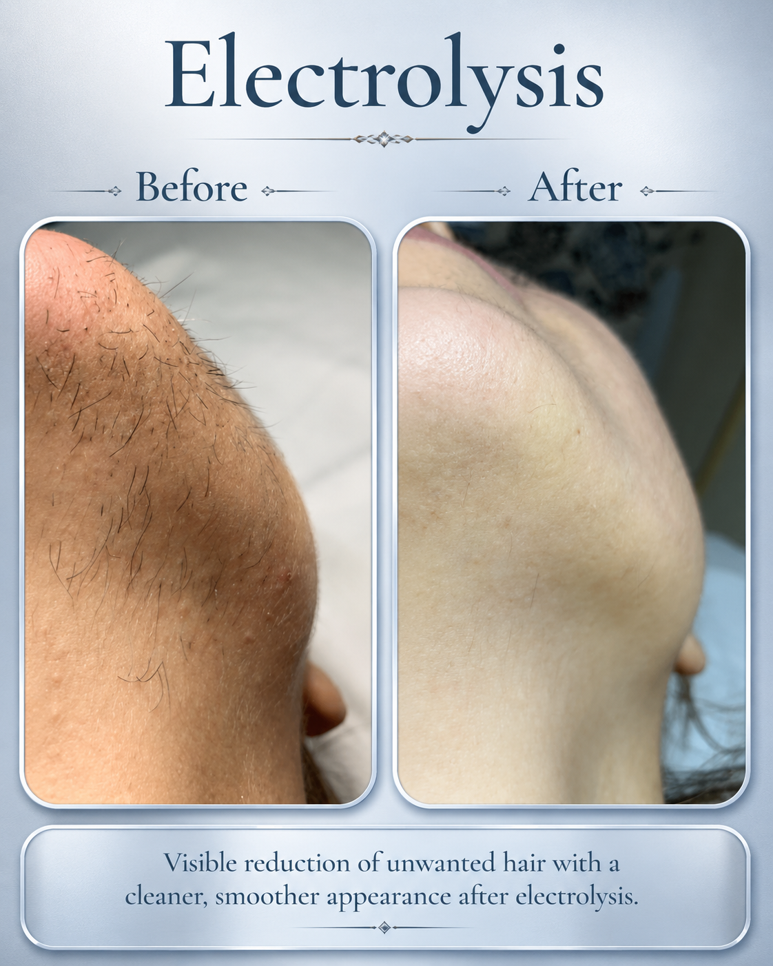 Electrolysis before and after result at BeautyGene Clinic — case 6