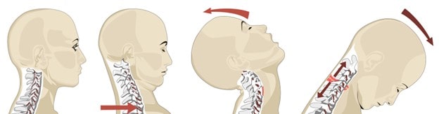 Atlanta Whiplash Injury Clinic - How Does Whiplash Occur?